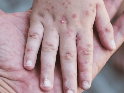 Ilustrasi penderita Campak/Foto: Istimewa