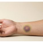 Lima penyebab medis munculnya memar tanpa cedera: dari perubahan aktivitas, penuaan kulit, efek obat, hingga kondisi serius yang perlu diwaspadai.